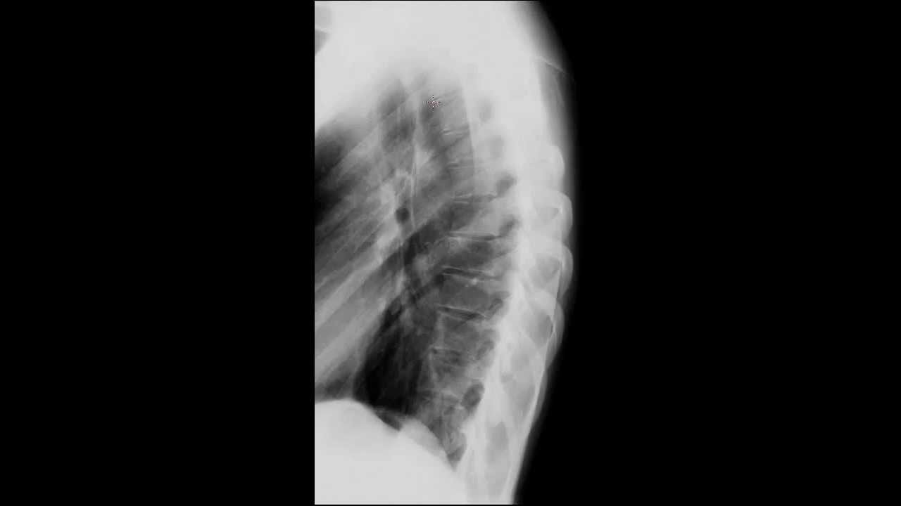 Thoracic Spine Radiology Tutorial