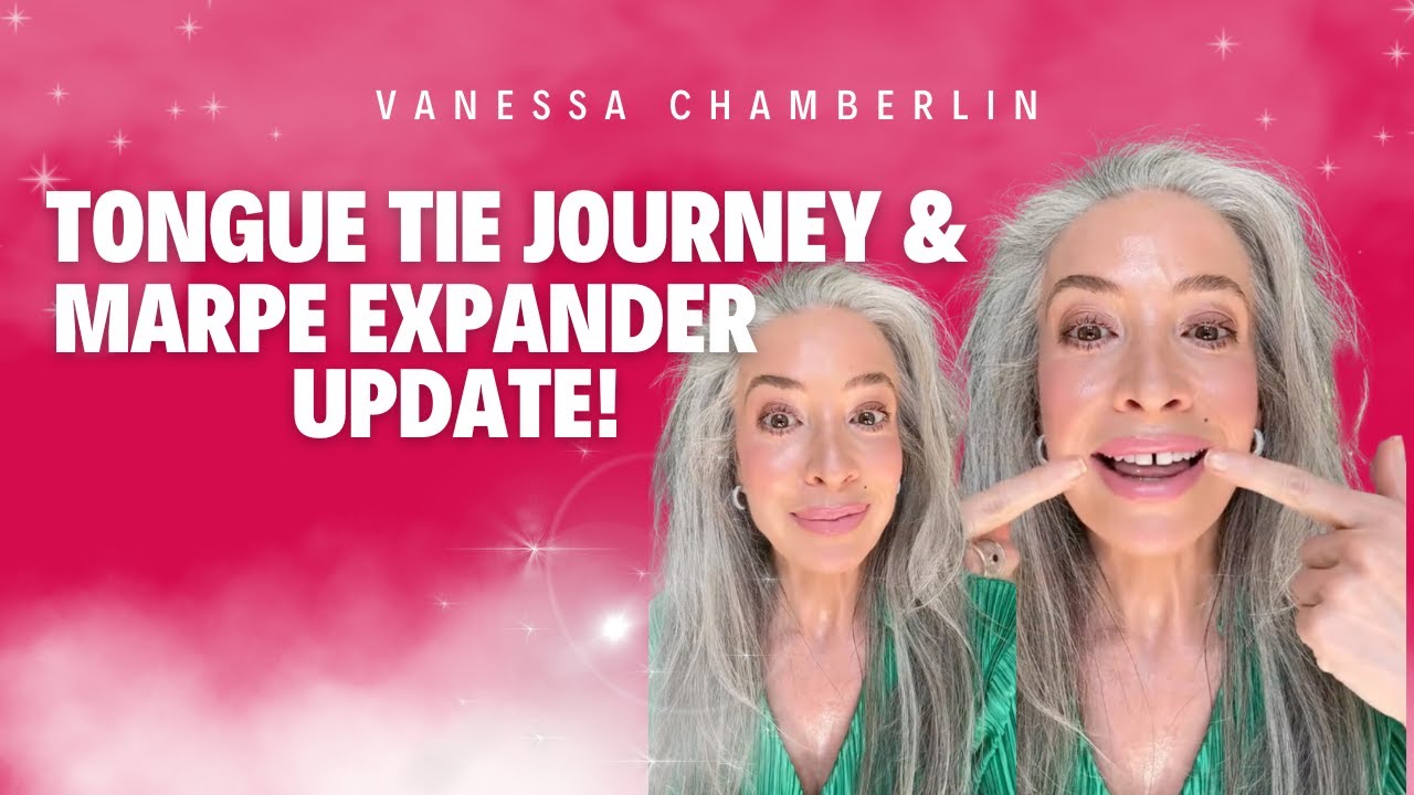 My gap is growing  Tongue tie journey  marpe expander update