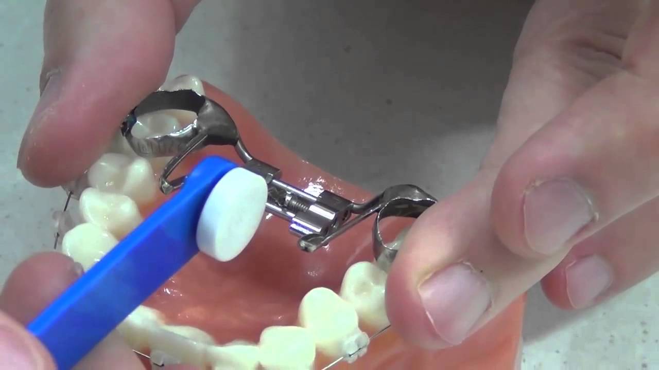 How do you turn your fixed orthodontic expander?