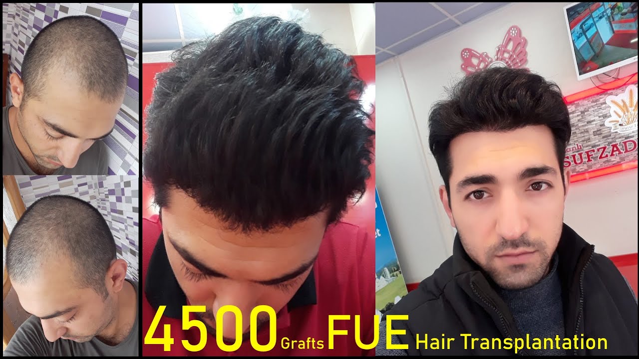 FUE Hairline Transplant Full Coverage / Completo Cubierto Trasplante Capilar Técnicas FUE