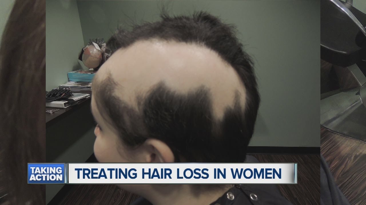 Treating hair loss in children