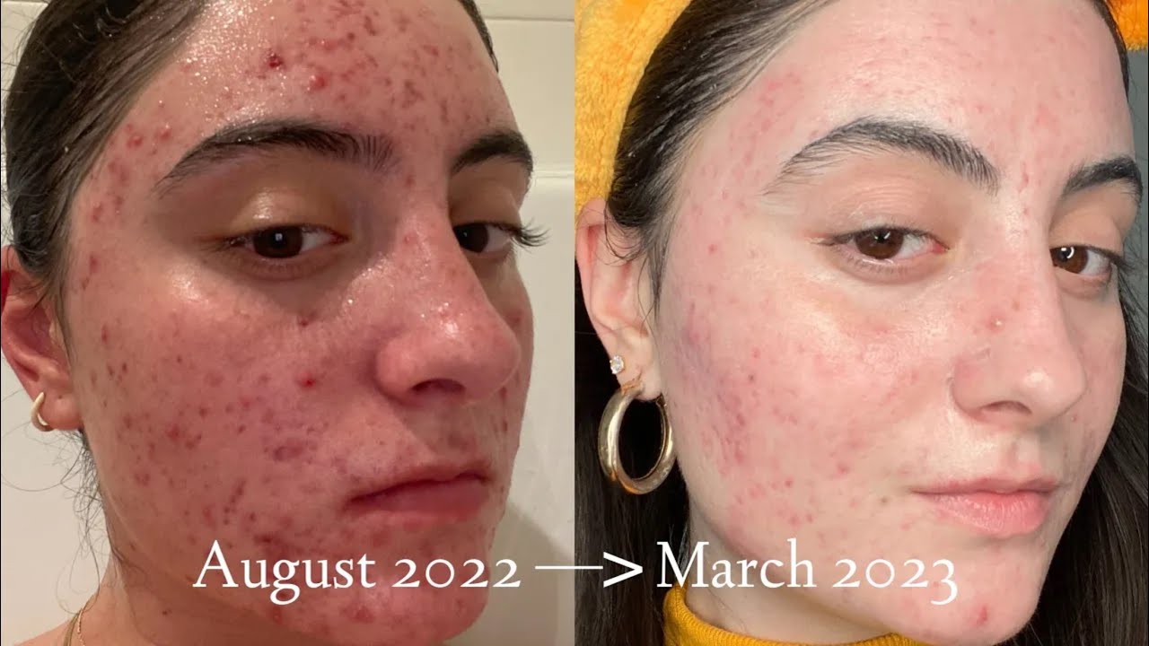 SKINCARE THAT IS HELPING TO HEAL MY HORMONAL ACNE & SCARS