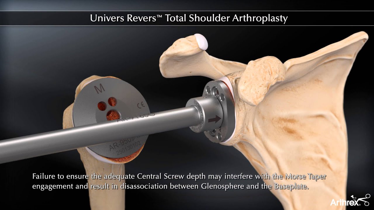 Тотальная артропластика плечевого сустава Univers Revers™