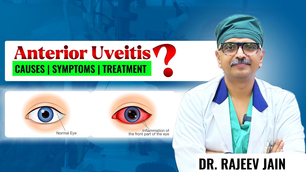Treatment of Anterior Uveitis by Dr. Rajeev Jain | Know Causes and Symptoms