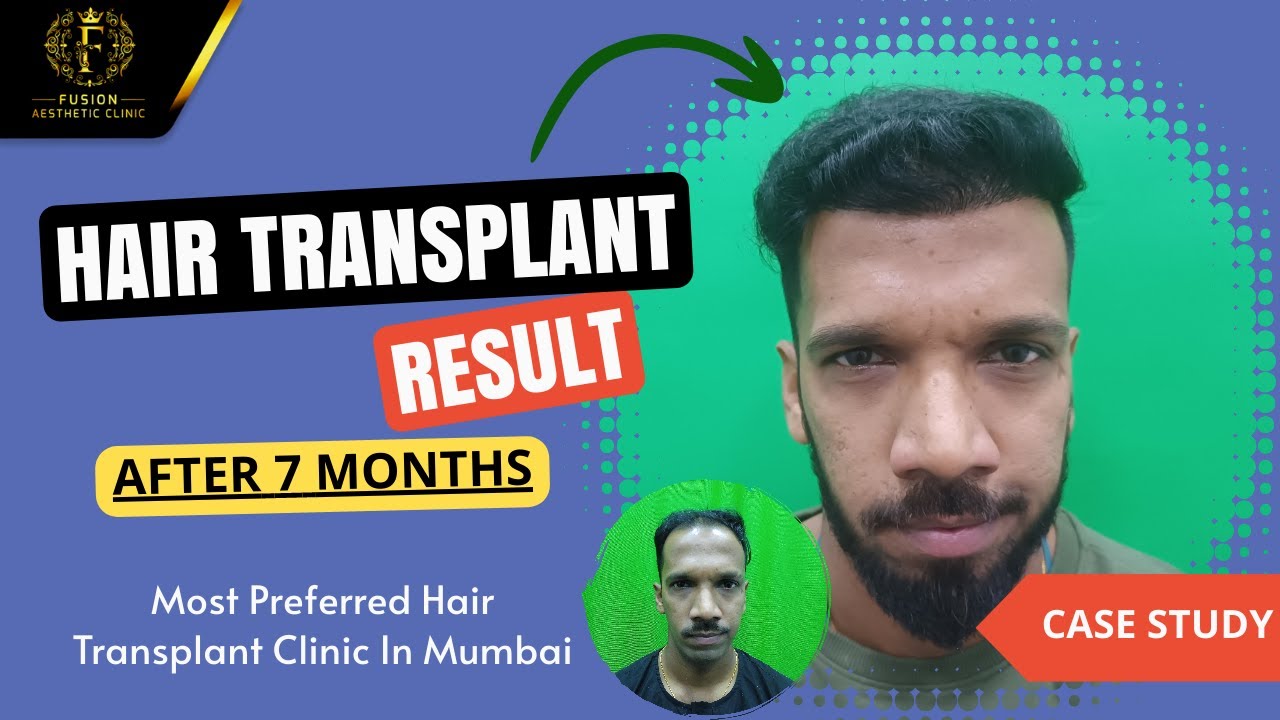 Case Study: Amazing Hair Transplant Result |Patient Review |Hair Transplant Journey |Dr. Pranil More