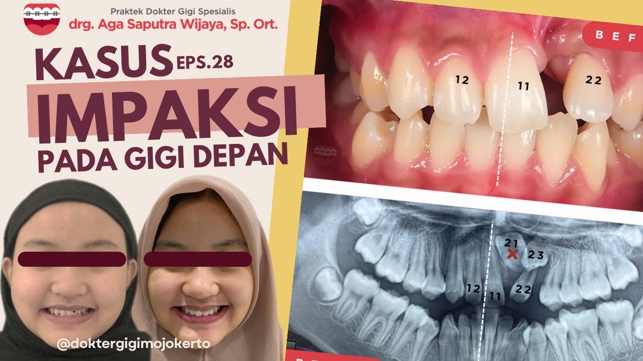 Kasus Impaksi Pada Gigi Depan Eps. 28