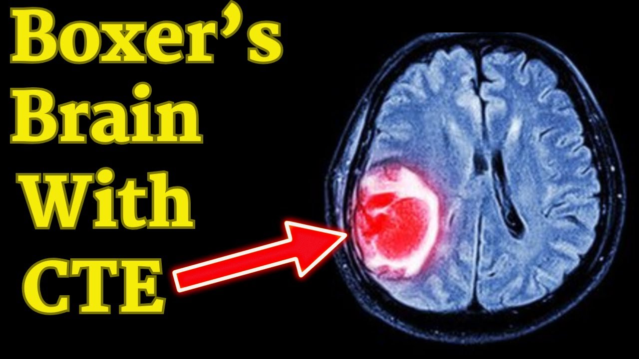 CTE Anatomy Explained | MMA Edition (Part 1/3)