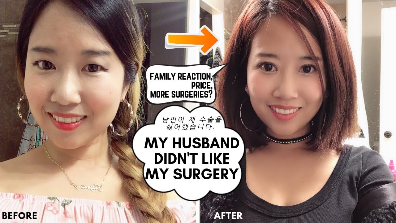 Eyelid surgery : Family's Reaction, Price, More Plastic surgeries? Q&A Vlog ep. 180