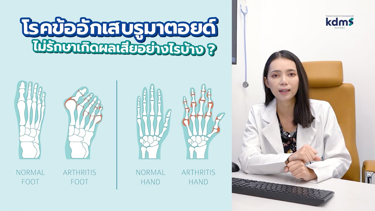 โรคข้ออักเสบรูมาตอยด์ ไม่รักษาเกิดผลเสียอย่างไร?
