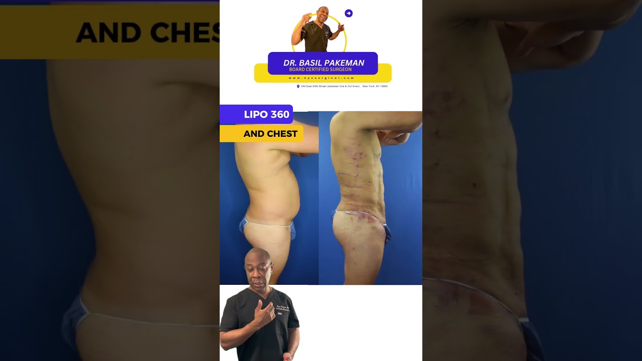 Lipo of Abdomen, chest and flanks with Dr. Manhattan. Natural looking
