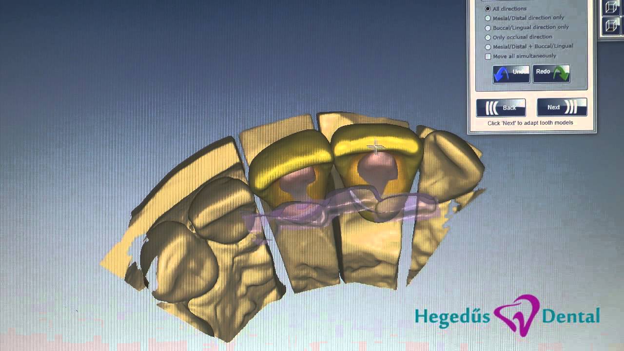 Hegedűs Dental Fogászat Budapest - PMMA korona