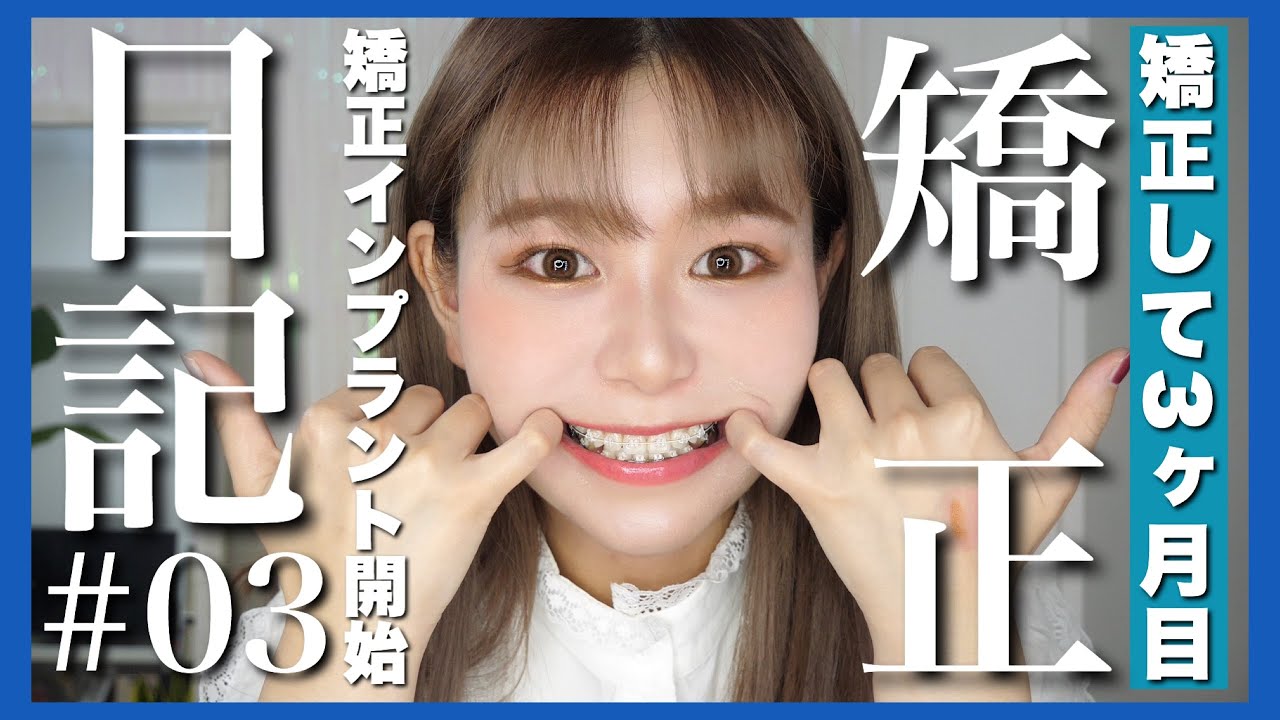 【矯正日記#3】3ヶ月経過報告🌈口元の変化でてきた！【矯正インプラント】by 桃桃