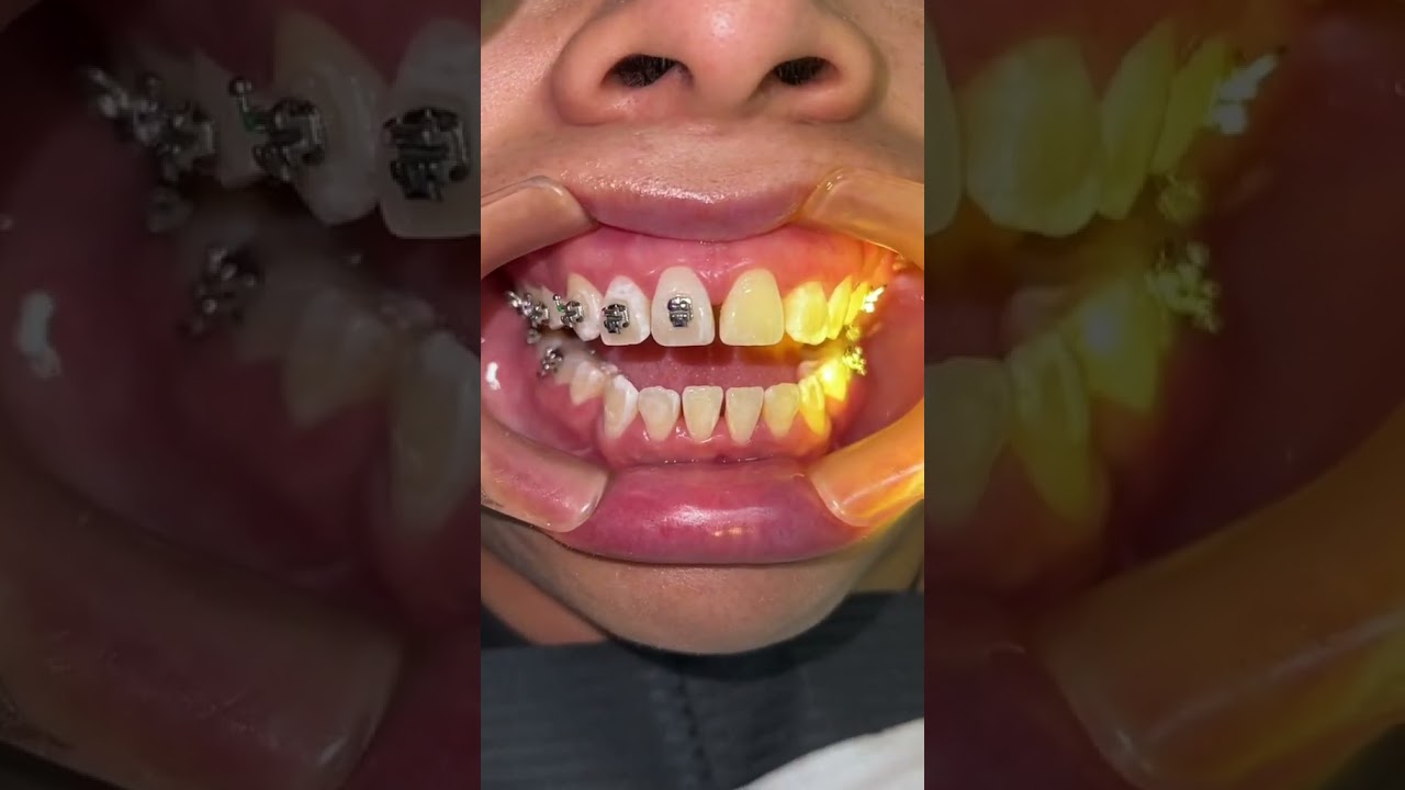 Colocaci&oacute;n de brackets autoligado