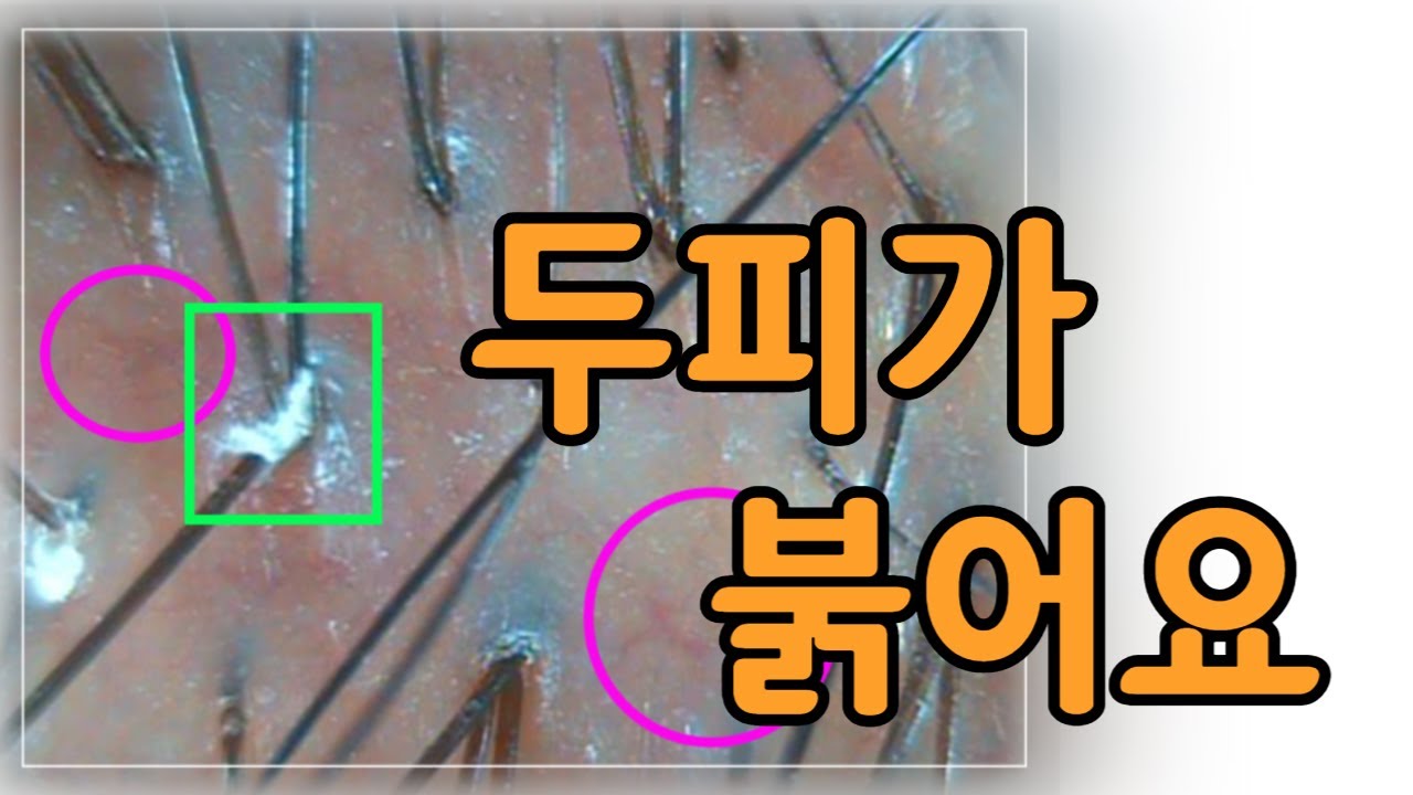 두피가 붉어요.  두피열이 심해요