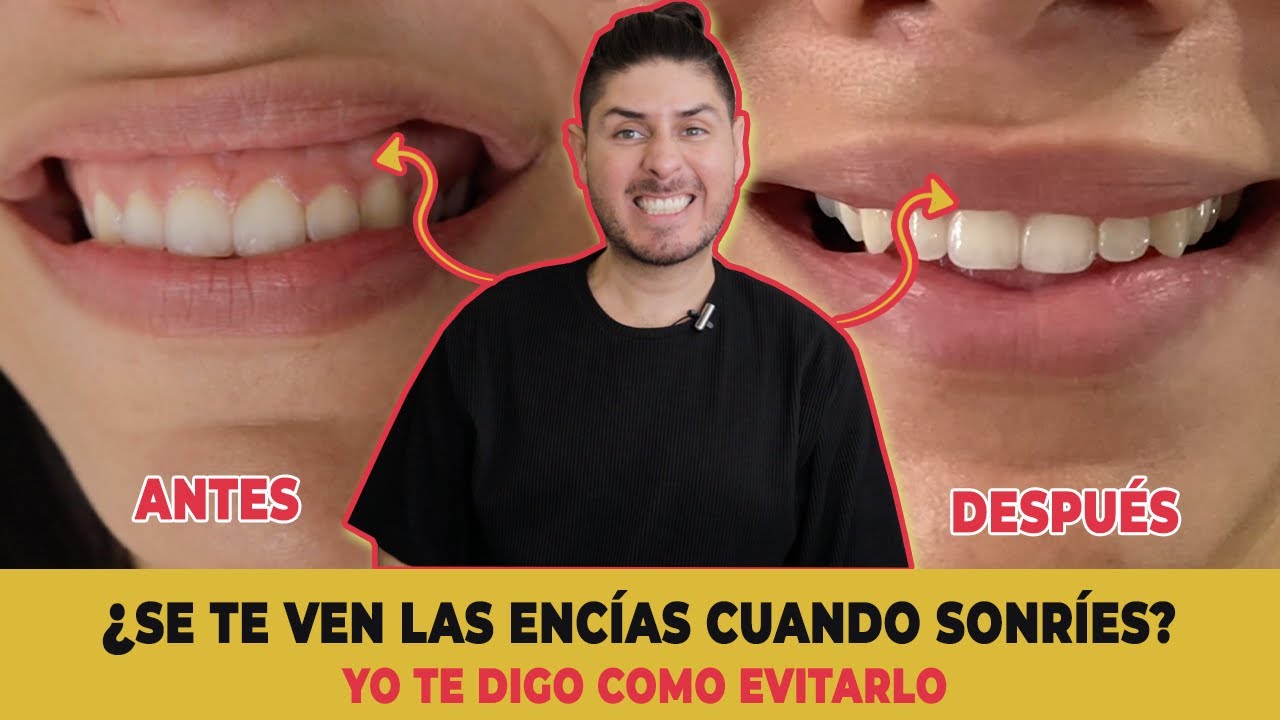 ¿Cómo eliminar la sonrisa gingival? - Sonrisa alta / encías grandes | DOCTOR LEMUS