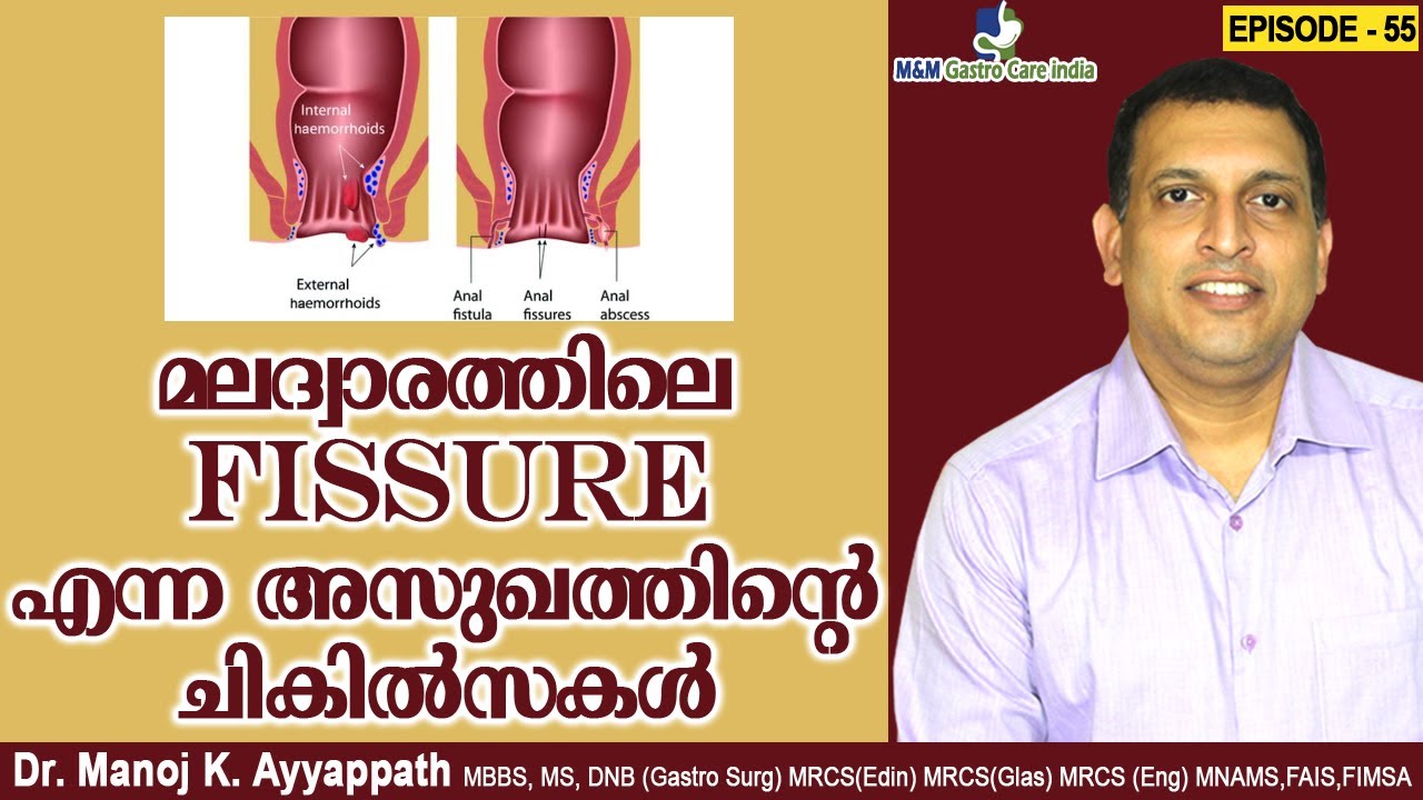 മലദ്വാരത്തിലെ fissure എന്ന അസുഖത്തിന്റെ ചികിൽസകൾ | M&M Gastro Care India