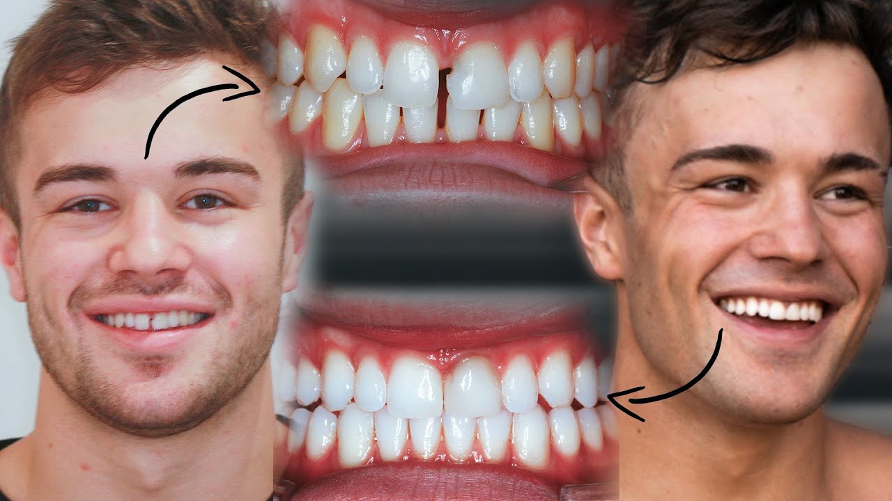 One Year Teeth Transformation  // FULL Invisalign Experience