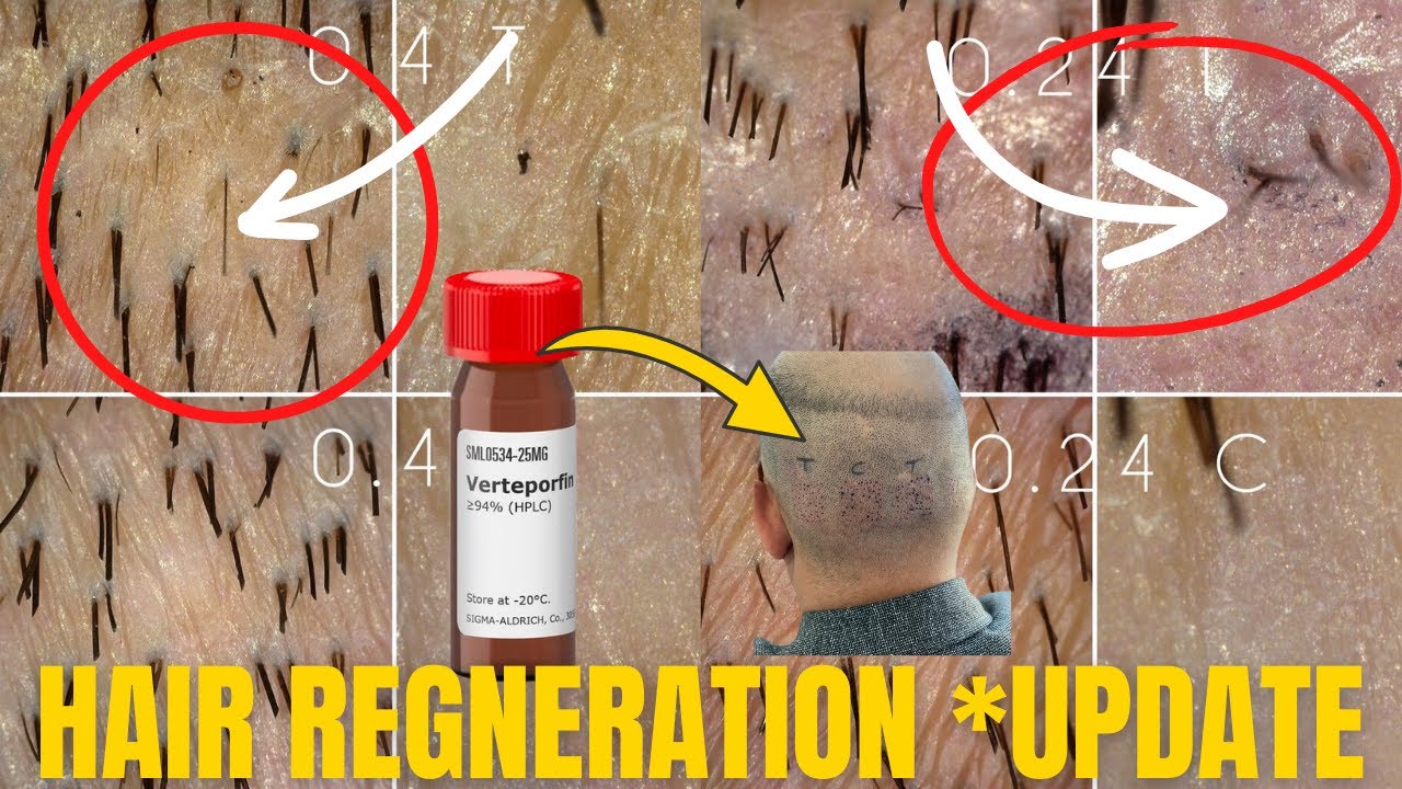 *UPDATE Verteporfin Human Trials with Dr. Barghouthi- Hair Transplant Network Podcast Ep -17