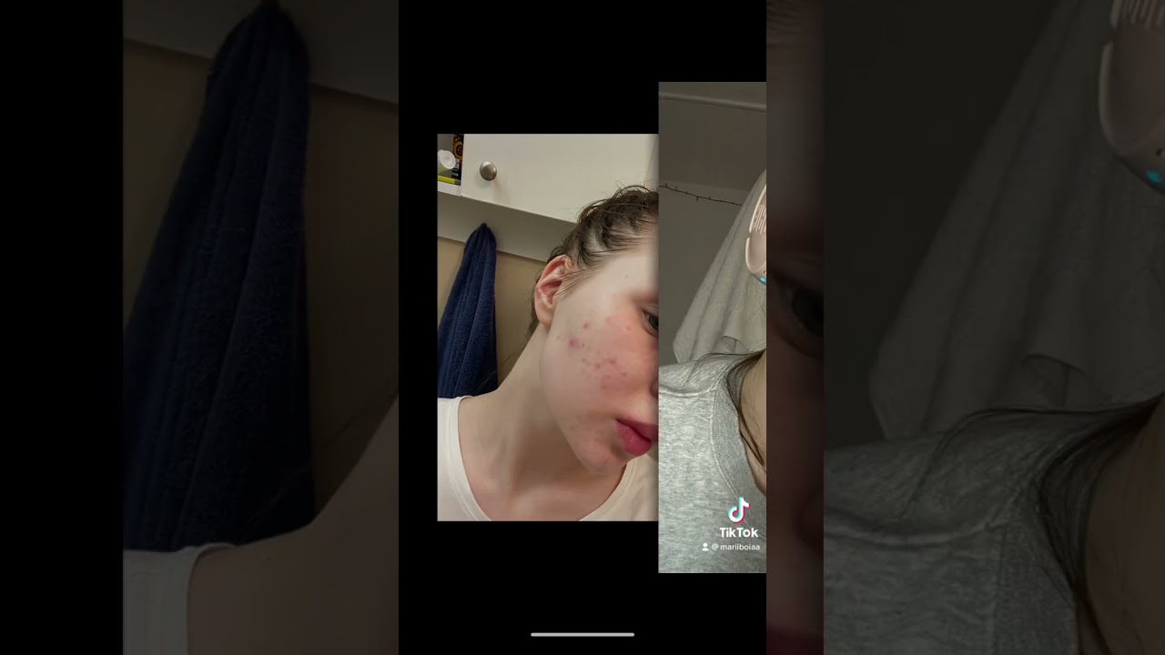 #acne #curacne