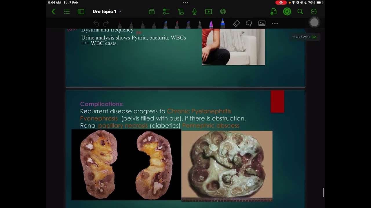  Urinary tract infection and obstruction pathology