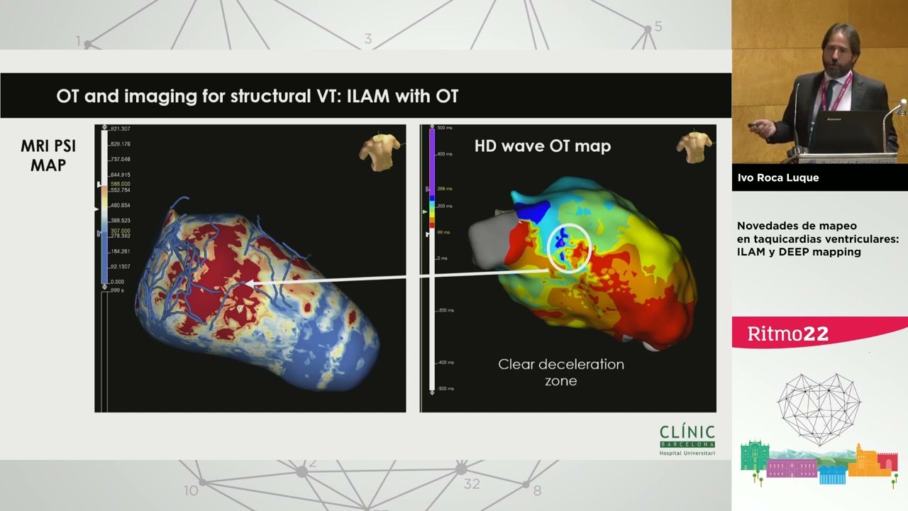 Ablación de taquicardia ventricular