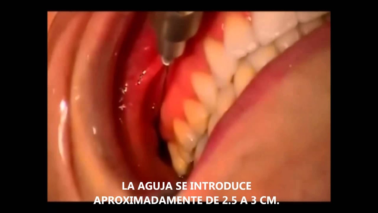 TECNICA DE VAZIRANI Y AKINOSI