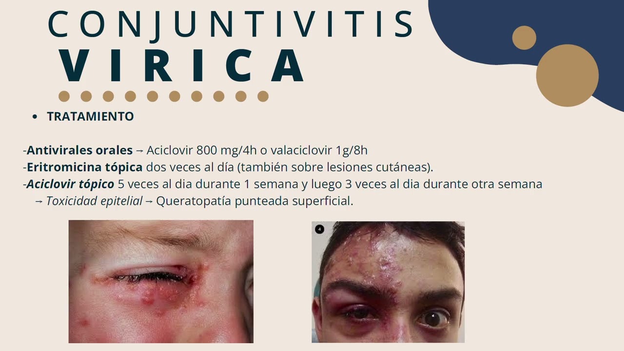 Diagnóstico diferencial del ojo rojo en AP. Sofía Muñoz Rojas. Ugc Loreto-Puntales