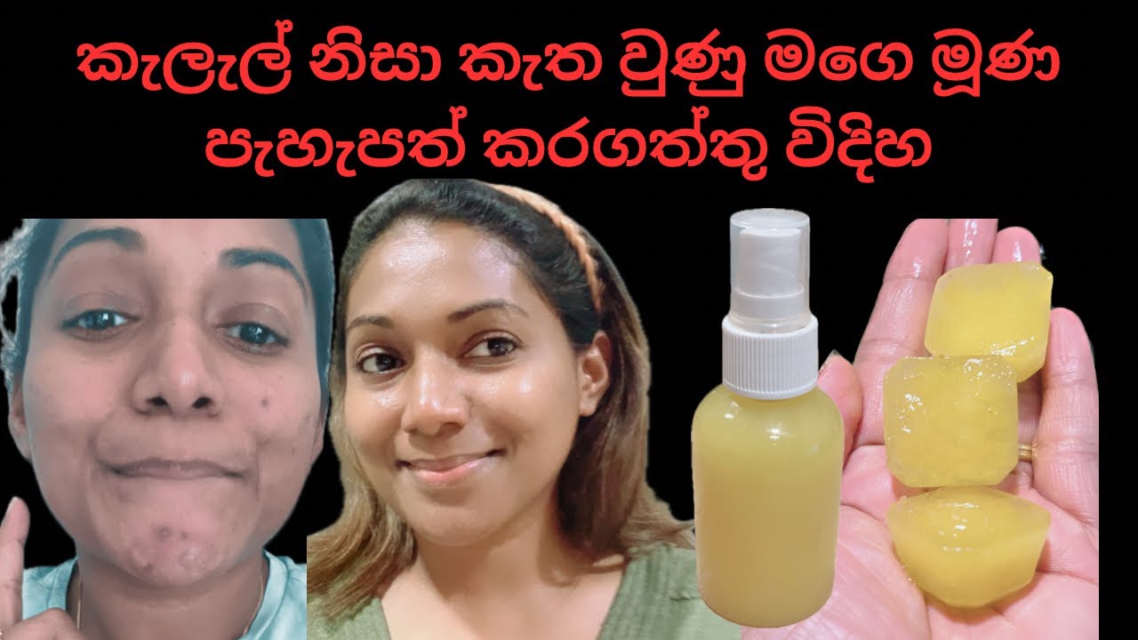 කැලැල් නිසා කැත වුණු මගෙ මූණ පැහැපත් කළ විදිහ/ලප කැලැල් නැති පැහැපත් මූහුණකට ගෙදරදිම සත්කාරයක්/
