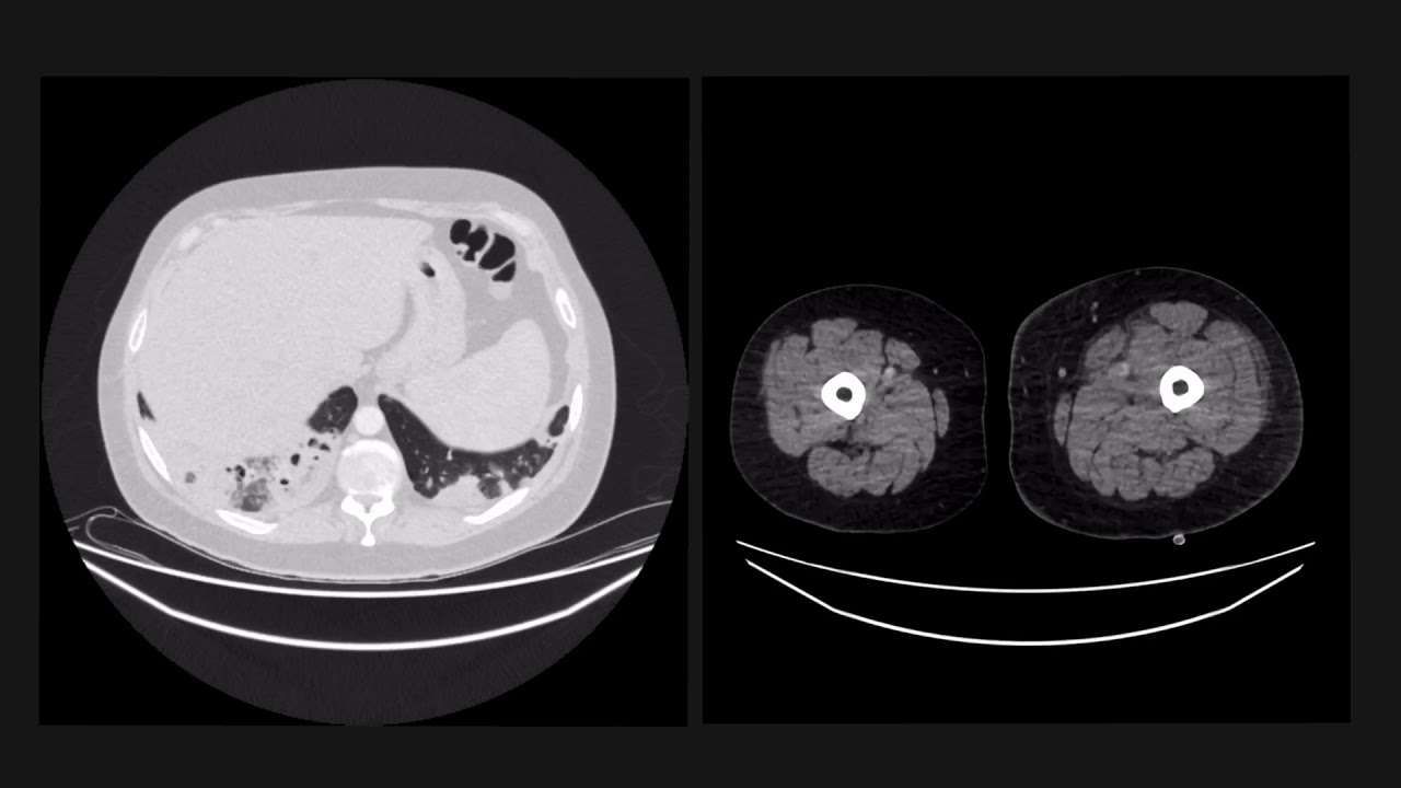 Cavitating lung lesions are a classic exam case!
