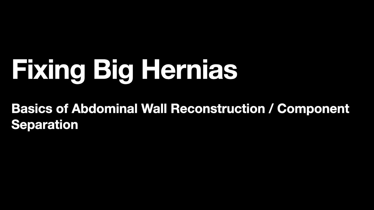 Fixing Big Hernias: Component Separation