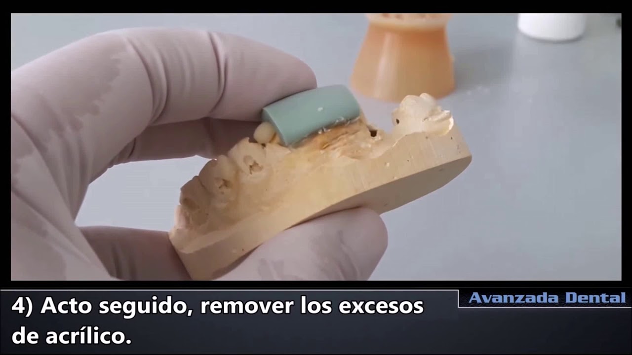 Confección Provisional Técnica de Llave de Silicona