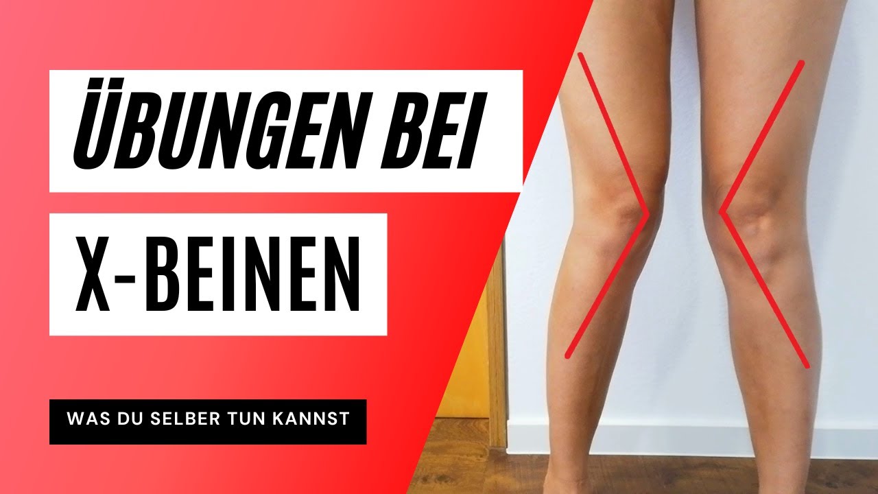 X-Beine - Welche Übungen sind geeignet?
