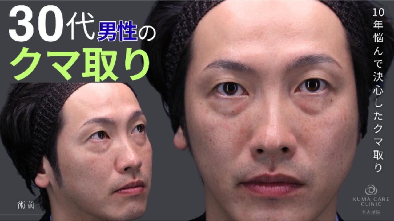 【クマ取り脱脂術】10年悩み続けた30代後半 男性
