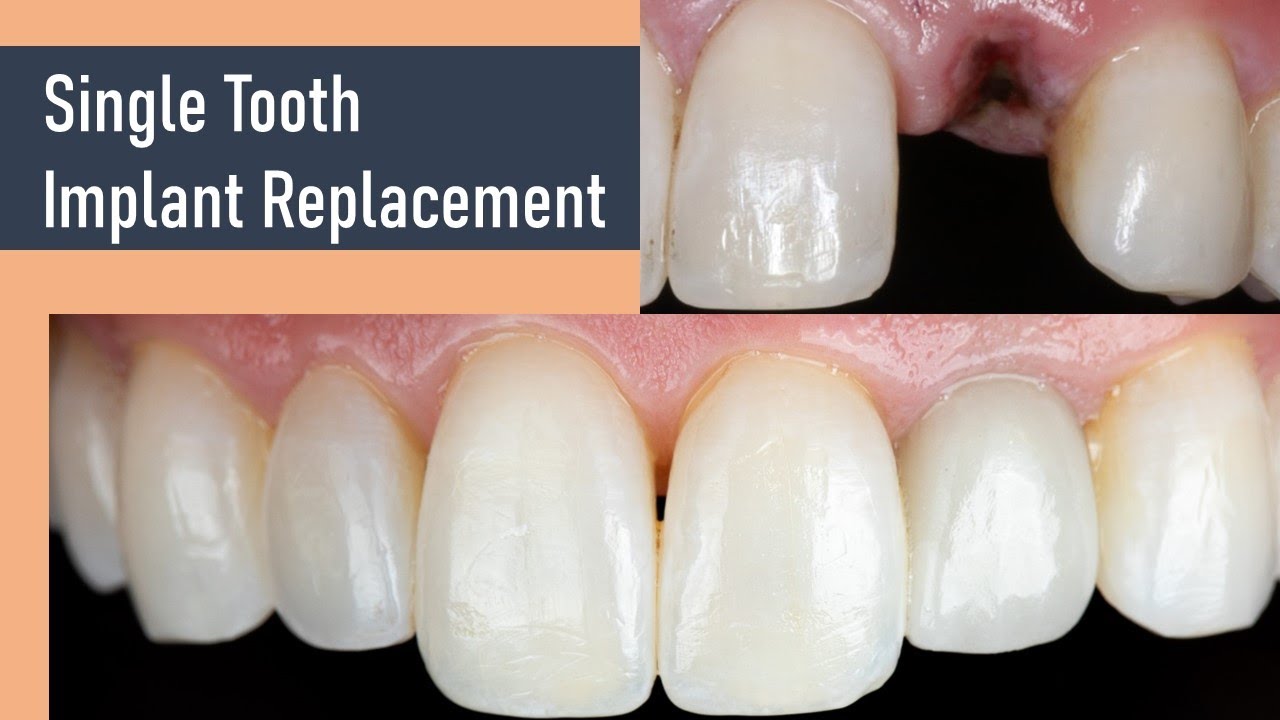 Single Tooth Dental Implant   Injury and Resorption!