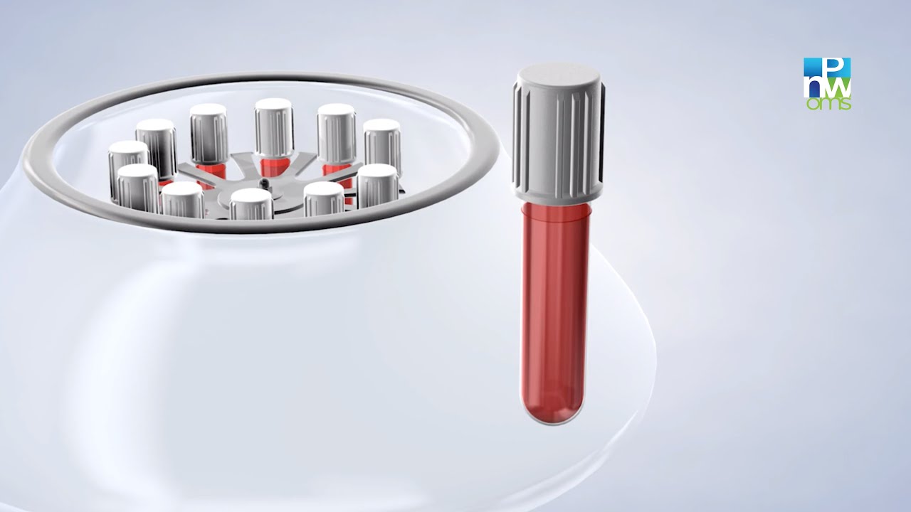 Platelet-Rich Growth Factors in King County WA | Pacific Northwest Oral & Maxillofacial Surgeons