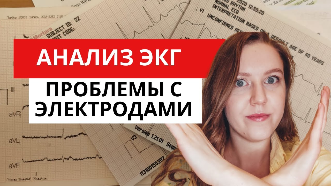 Анализ ЭКГ. Как понять по ЭКГ, что неправильно наложены электроды??