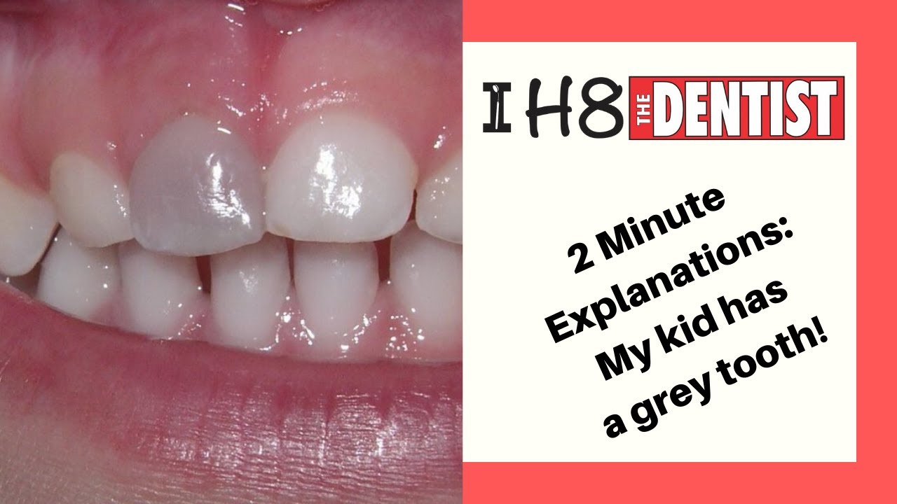 2 Minute Explanations: My Kid Has A Grey Tooth!