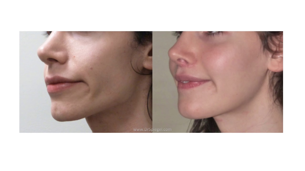 Cheek Implants