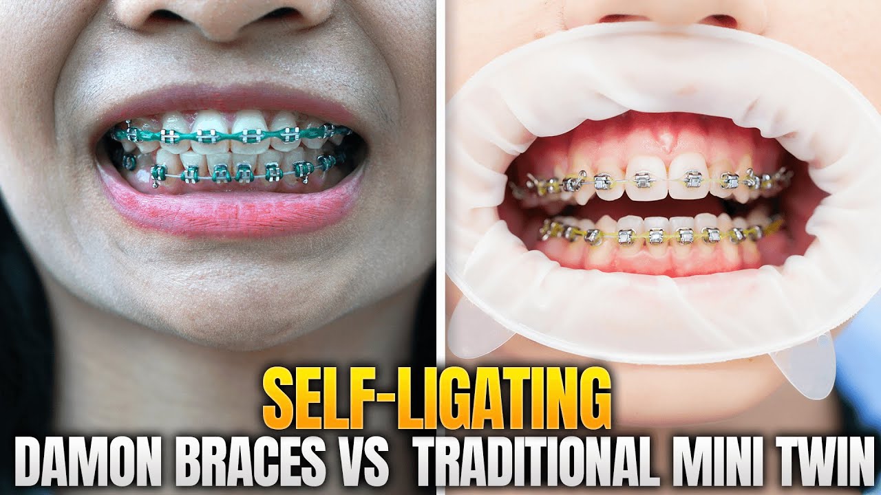 Self-Ligating / Damon Braces vs  Traditional Mini Twin