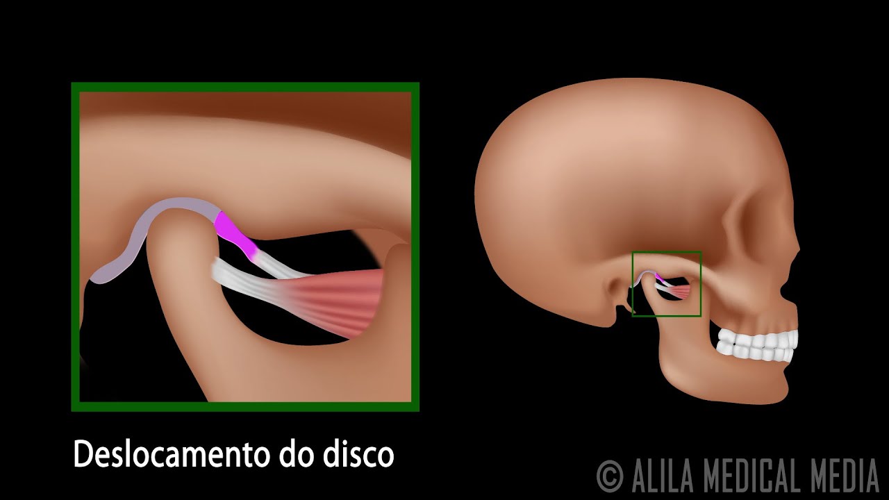 Articulação Temporomandibular (ATM) e Deslocamento de Disco. Alila Medical Media Português.