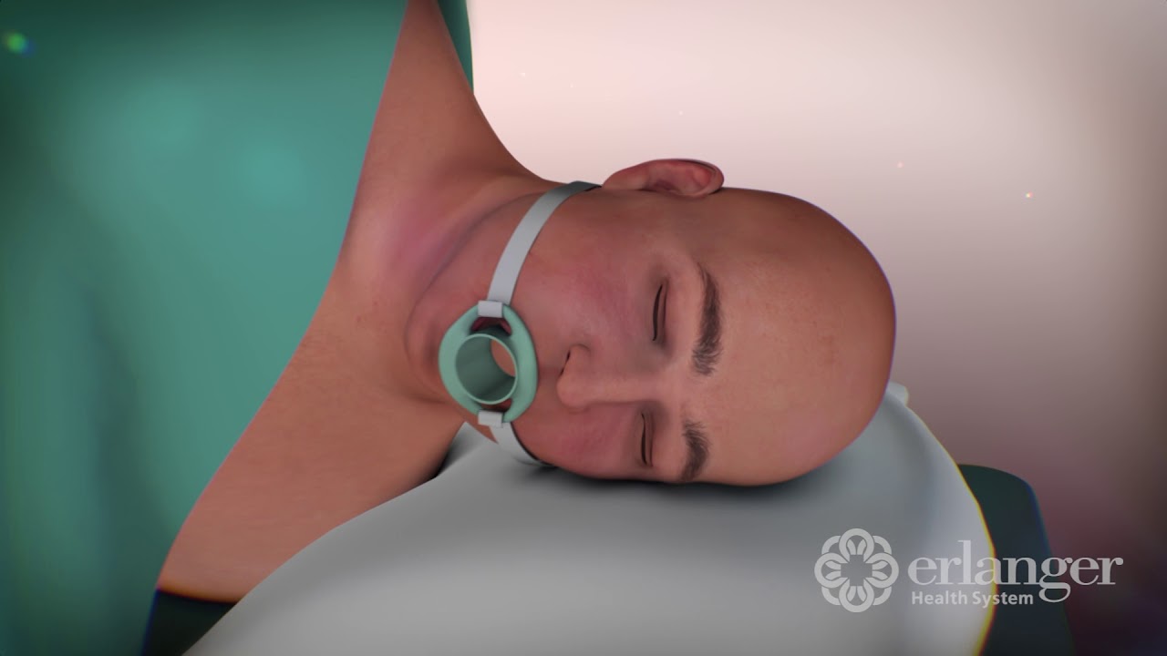 TIF Procedure for Acid Reflux - Erlanger Health System