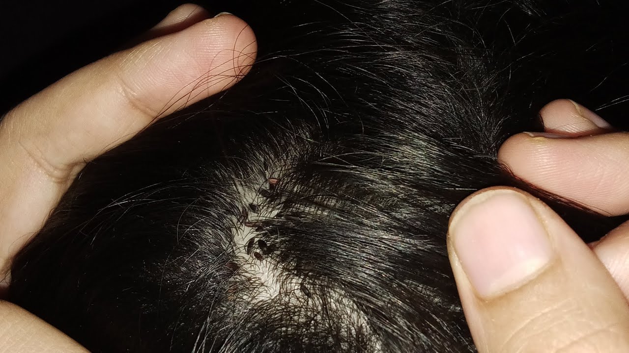 Lice  Attack On little girl head named Tofee😱♥️😱🪰