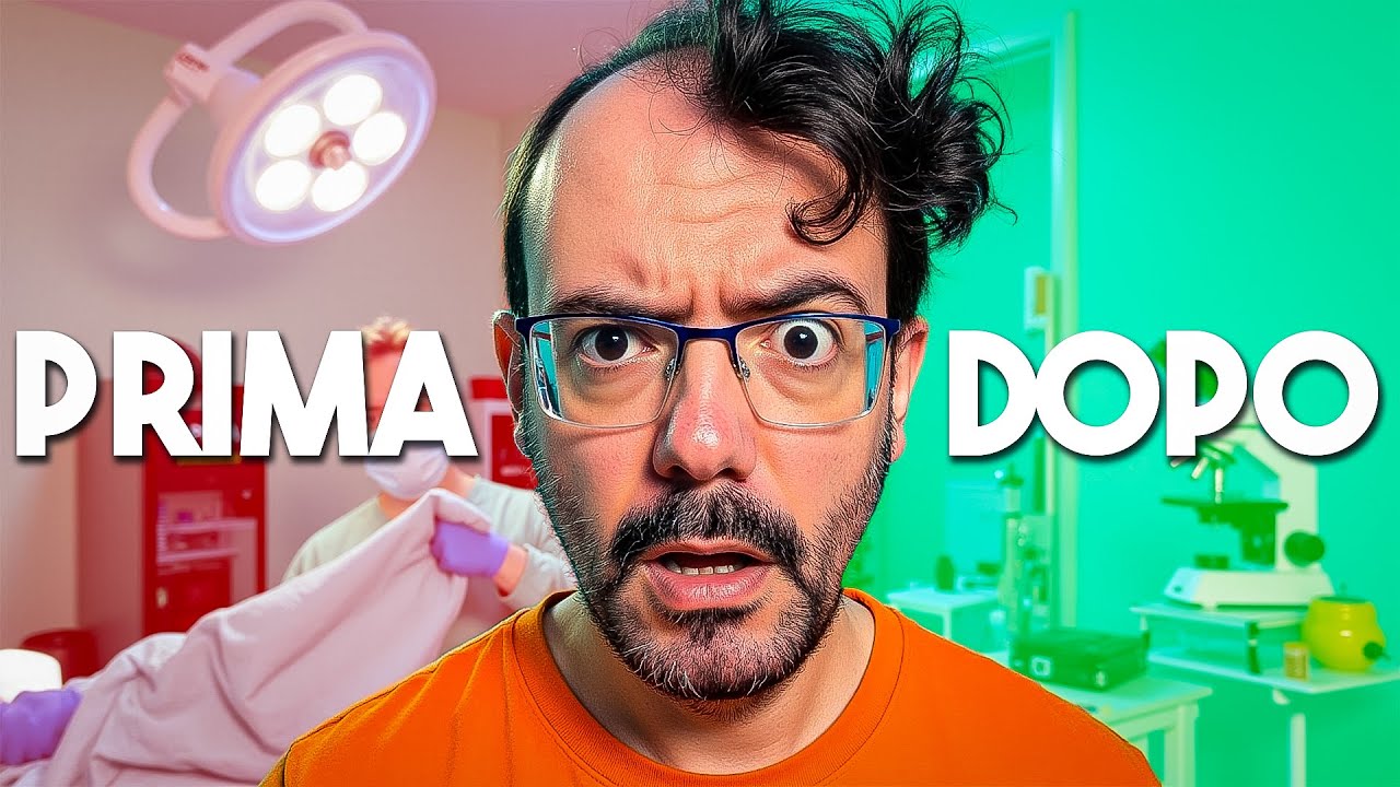 Il mio trapianto di capelli - 2 anni dopo