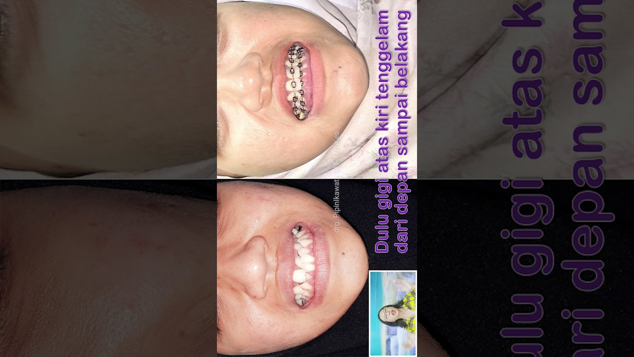 GIGI SUPER BERANTAKAN CAKIL SUDAH RAPI DAN NORMAL DIRAWAT BEHEL || PART 4 OF 4