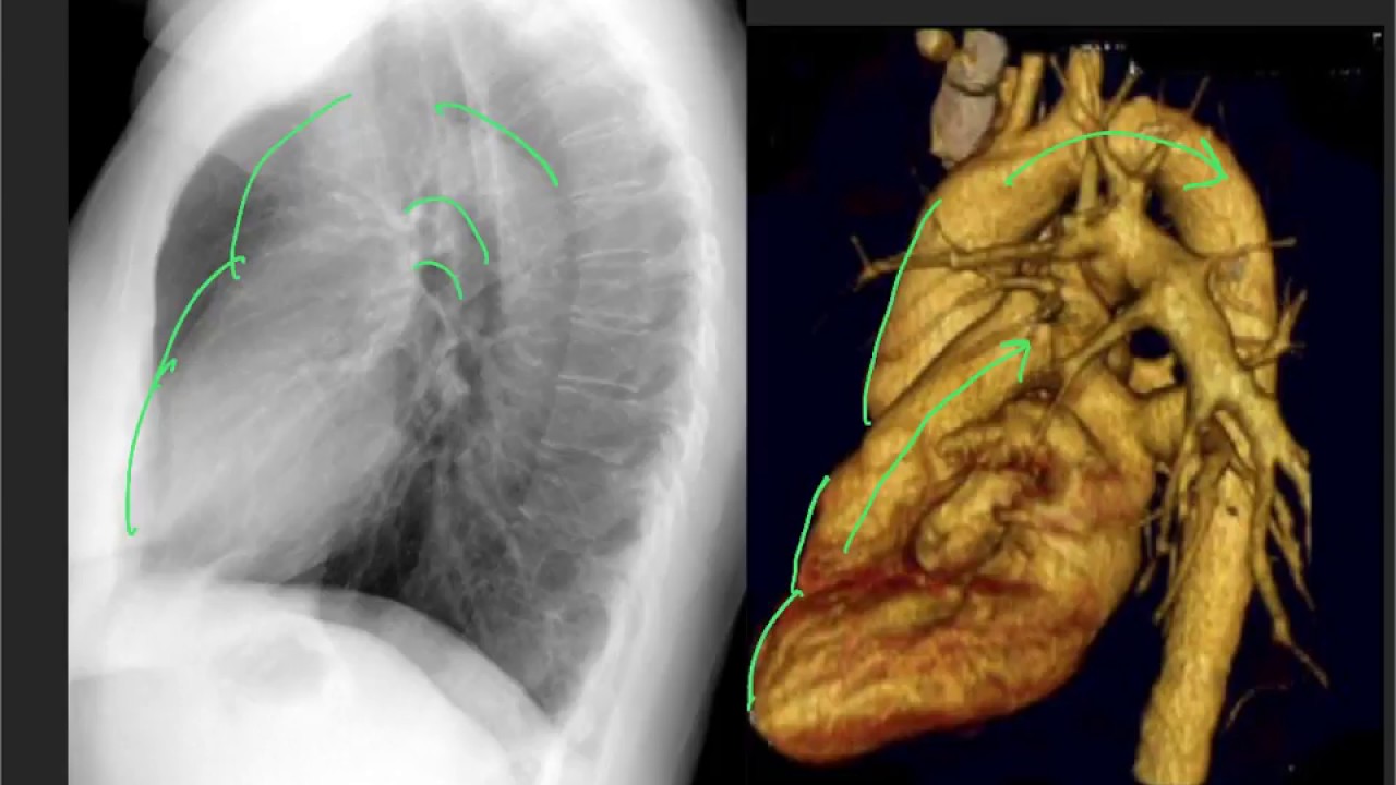 Anatomy on the lateral CXR