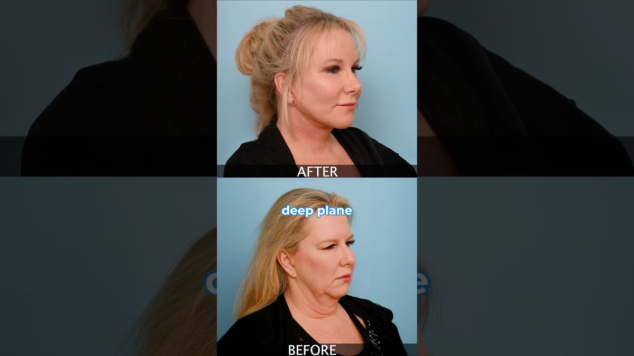 How Long Do Deep Plane Facelift Results Last? #DeepPlaneFacelift