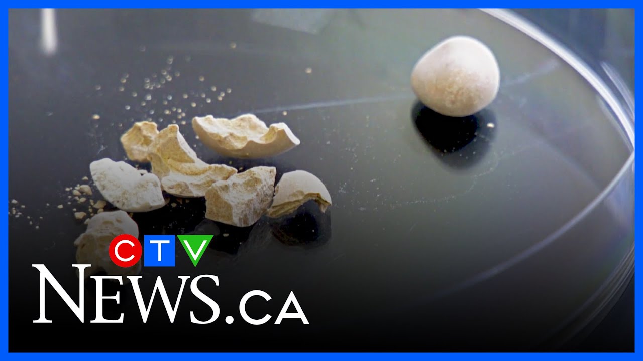Minimally invasive procedure could change kidney stone treatments