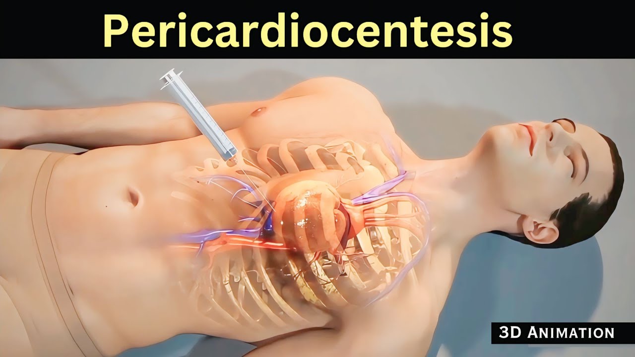 Pericardiocentesis | removing excess amount fluid from pericardium
