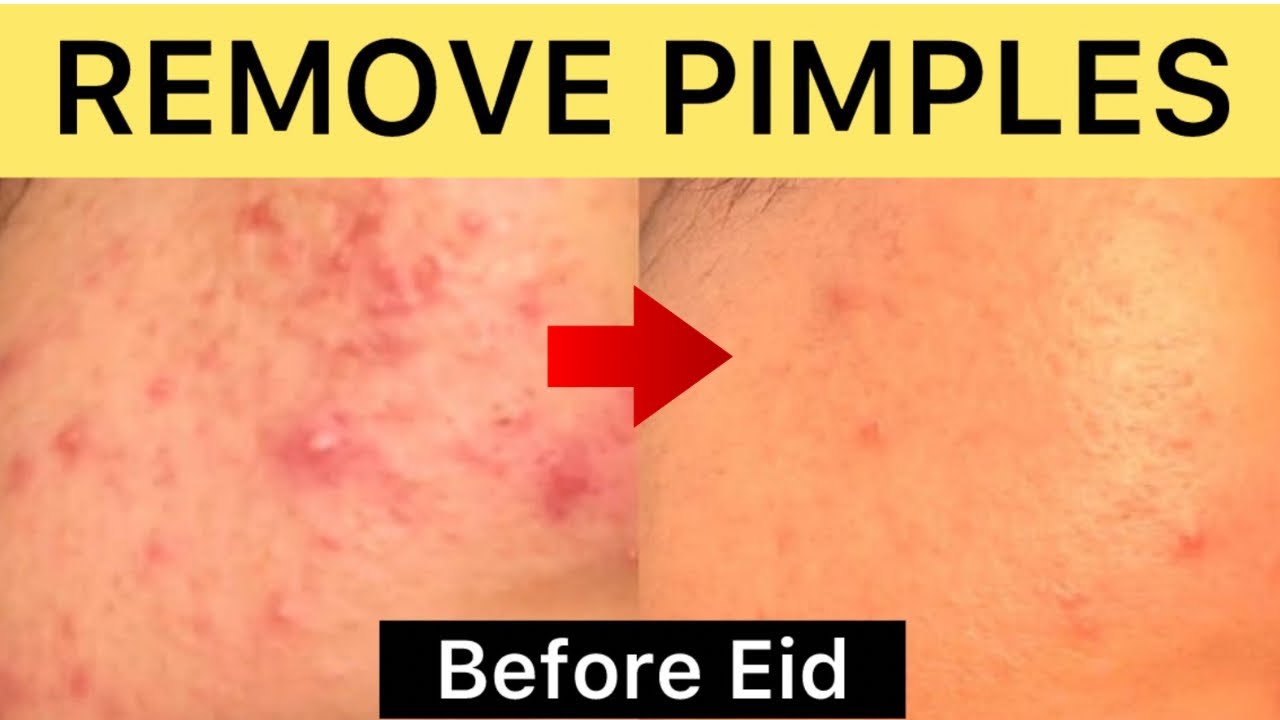 GET RID OF ACNE Before Eid *𝗜𝗡𝗦𝗧𝗔𝗡𝗧𝗟𝗬*
