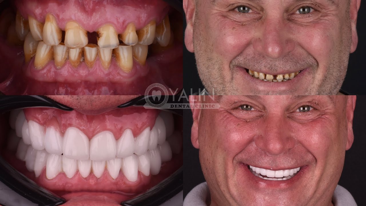 The Treatment Story of Our English Patient David | Best Dental Clinic in Antalya|YALIN DENTAL CLINIC